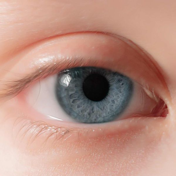 What is myopia?